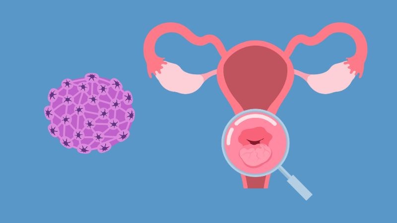 HPV 16 và 18 đã được chứng minh liên quan nhất đến ung thư cổ tử cung