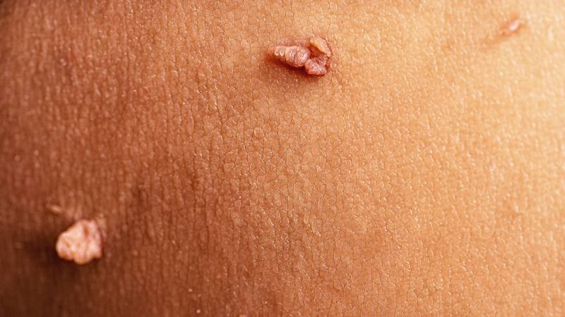 Hãy đi gặp bác sĩ nếu xuất hiện mụn cóc bất thường