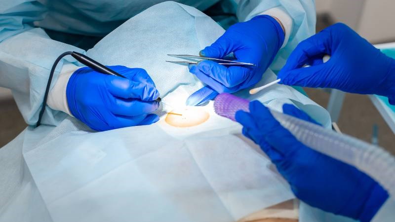 Sùi mào gà có thể điều trị bằng phương pháp đốt điện