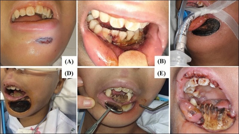 Bệnh cam tẩu mã giai đoạn cấp tính là một trường hợp cấp cứu y tế