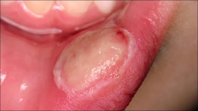 Trẻ suy dinh dưỡng có biểu hiện viêm loét vùng miệng nên được đi khám