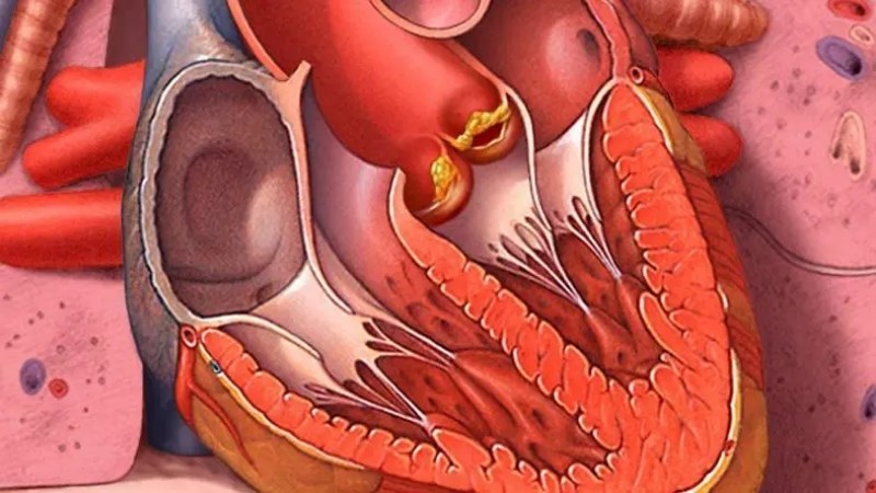Hẹp van động mạch phổi có thể làm tăng nguy cơ viêm nội tâm mạc nhiễm khuẩn