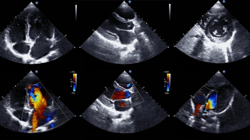 Siêu âm tim là xét nghiệm quan trọng giúp chẩn đoán hẹp van động mạch phổi