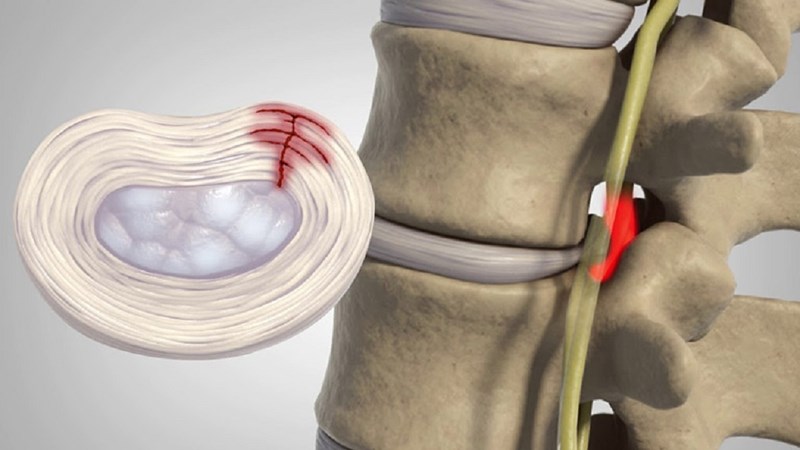 Thoát vị đĩa đệm nội xốp (IDD) được đặc trưng bởi sự biến dạng nhân nhầy