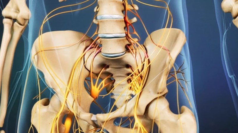 Thoát vị đĩa đệm nội xốp có thể dẫn đến hội chứng chùm đuôi ngựa