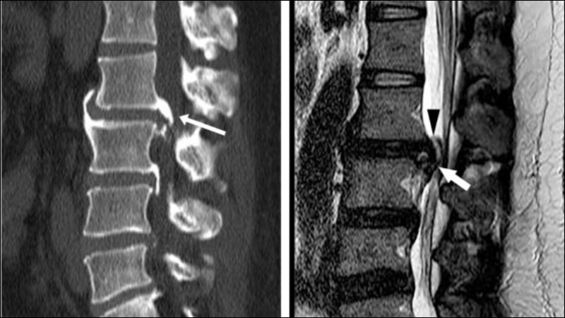 MRI cho phép bác sĩ khảo sát một cách chi tiết mức độ tổn thương đĩa đệm