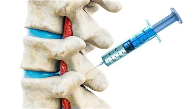 Tiêm steroid nội khoa có thể được chỉ định trong thoát vị đĩa đệm nội xốp