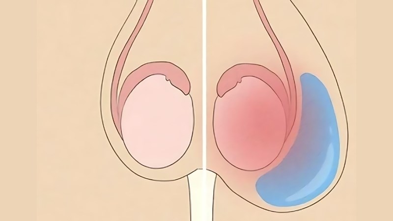 Tinh hoàn có dấu hiệu viêm nhiễm khi bị tràn dịch ra ngoài Tinh hoàn có dấu hiệu viêm nhiễm khi bị tràn dịch ra ngoài