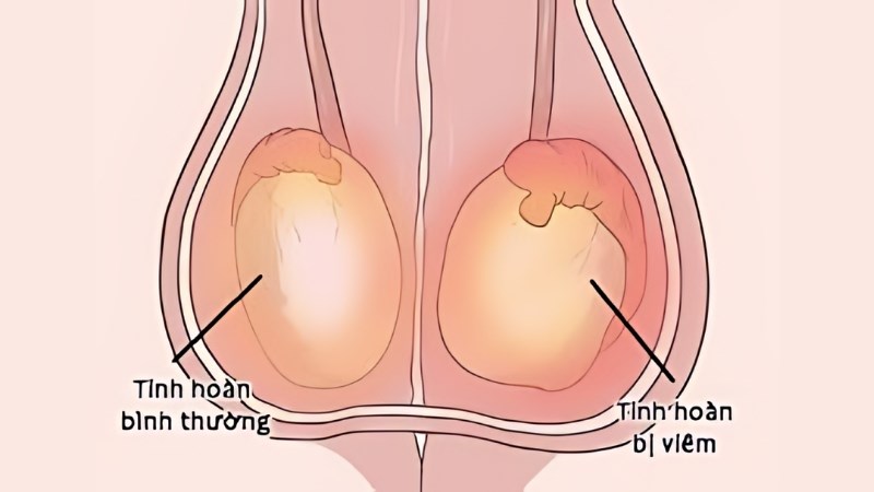 Vi khuẩn và virus là tác nhân làm cho dịch viêm bị ứ đọng và gây vi vôi hóa tinh hoàn Vi khuẩn và virus là tác nhân làm cho dịch viêm bị ứ đọng và gây vi vôi hóa tinh hoàn