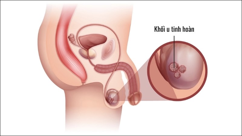 Các tế bào bất thường xuất hiện ở tinh hoàn Các tế bào bất thường xuất hiện ở tinh hoàn