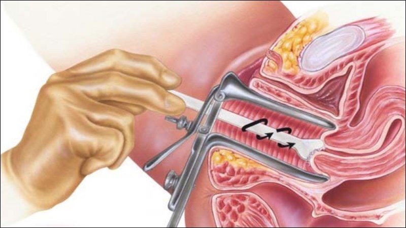 Xét nghiệm tầm soát ung thư cổ tử cung được khuyến cáo ở phụ nữ từ 30 - 60 tuổi