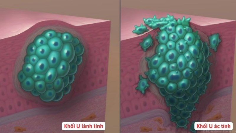 U lành tính không có khả năng xâm lấn và di căn