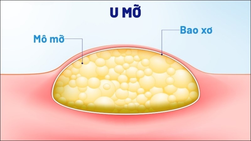 U mỡ là loại u lành tính phổ biến nhất