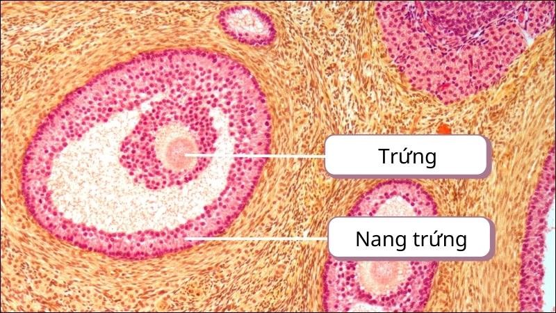 Suy buồng trứng sớm có liên quan đến các bất thường của nang trứng