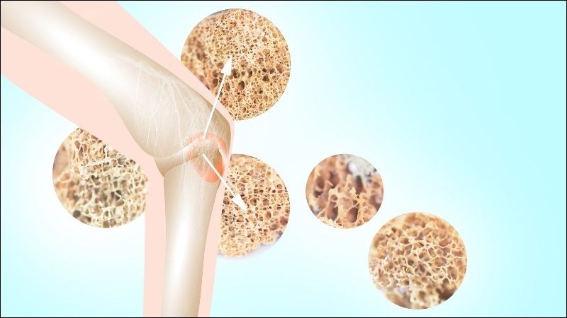Khi thiếu estrogen do suy buồng trứng sớm sẽ dẫn đến tình trạng loãng xương