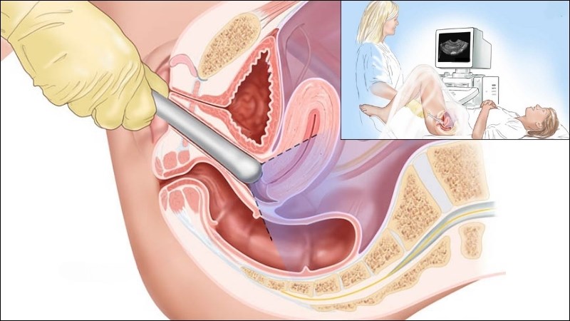 Siêu âm tử cung qua đường âm đạo giúp khảo sát kích thước, độ dày nội mạc tử cung Siêu âm tử cung qua đường âm đạo giúp khảo sát kích thước, độ dày nội mạc tử cung