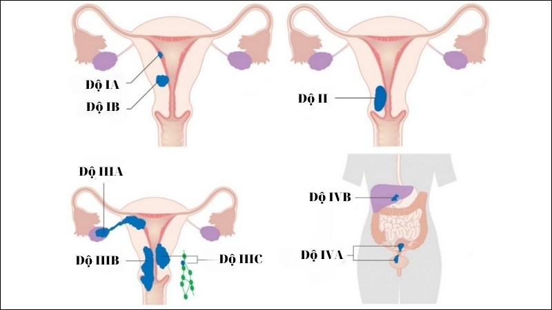 Có 4 giai đoạn chính trong ung thư nội mạc tử cung theo phân loại của FIGO Có 4 giai đoạn chính trong ung thư nội mạc tử cung theo phân loại của FIGO