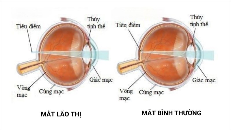 Thủy tinh thể co hồi do lão hóa là nguyên nhân gây ra tật lão thị Thủy tinh thể co hồi do lão hóa là nguyên nhân gây ra tật lão thị