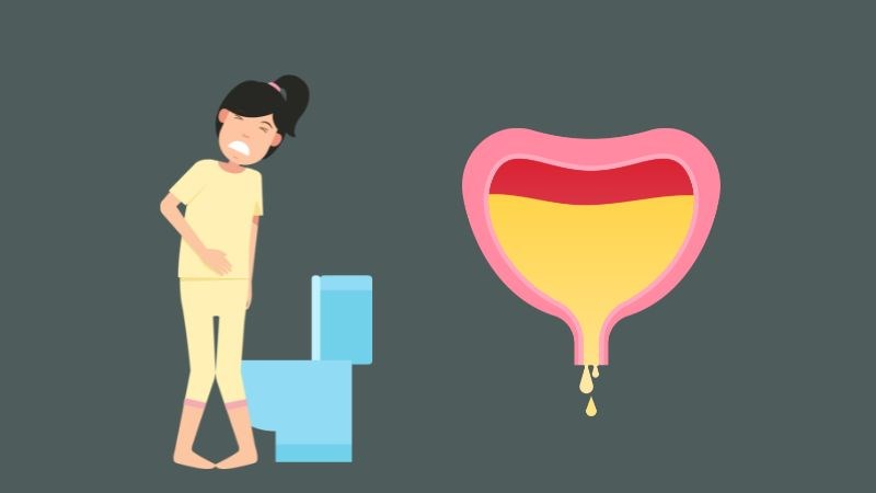 Bàng quang tăng hoạt là tình trạng tăng co bóp cơ bàng quang do kích thích
