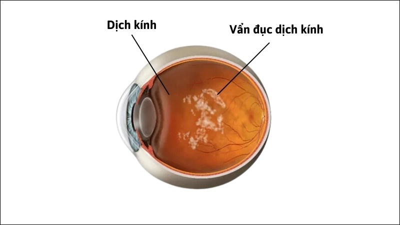 Vẩn đục dịch kính là tình trạng dịch kính mất đi tính trong suốt do các vẩn đục