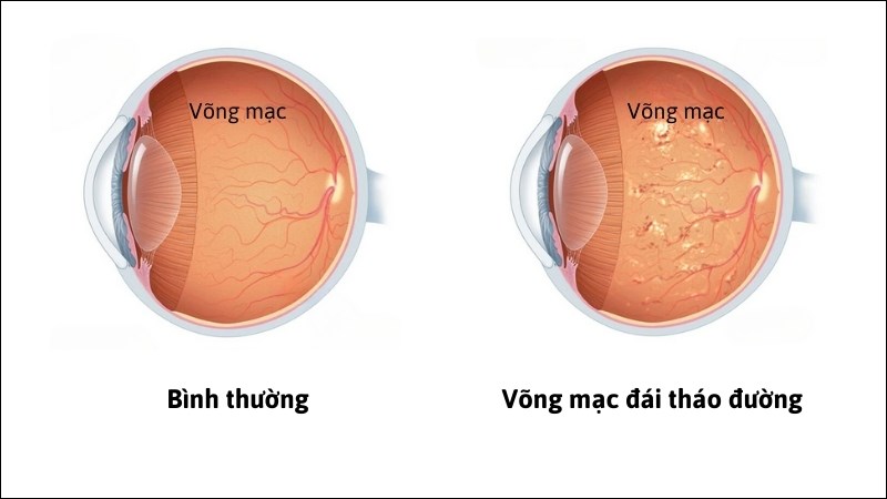 Võng mạc đái tháo đường có thể dẫn tới vẩn đục dịch kính
