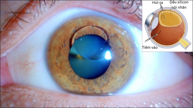 Giọt dầu nội nhãn được dùng trong phẫu thuật mắt có thể gây vẩn đục dịch kính