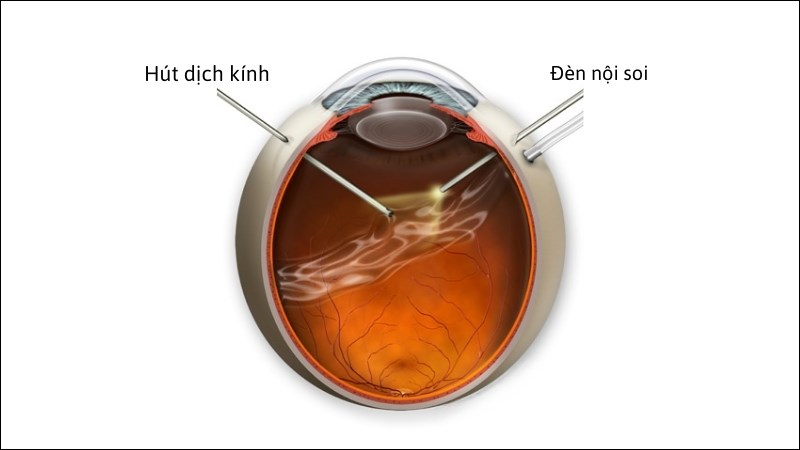 Phẫu thuật cắt dịch kính được cân nhắc khi vẩn đục gây cản trở tầm nhìn nhiều