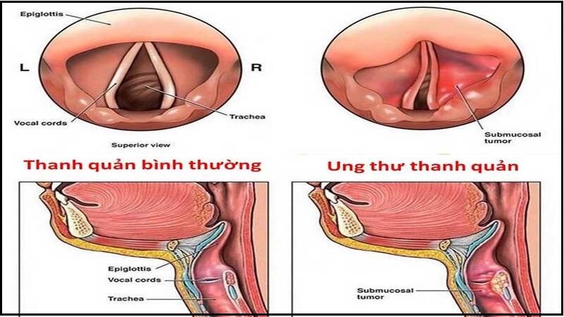 Ung thư thanh quản sẽ ảnh hưởng đến thanh quản và dây thanh âm Ung thư thanh quản sẽ ảnh hưởng đến thanh quản và dây thanh âm