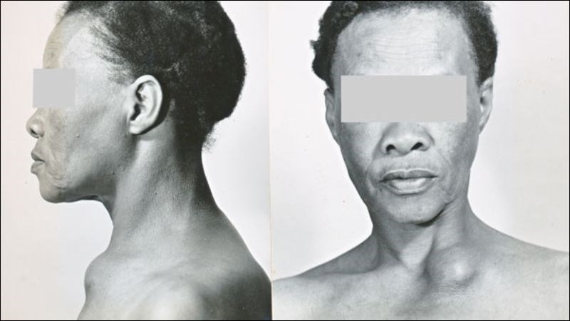 Hạch cổ do  Mycobacteria - một loại vi khuẩn gây bệnh lao 