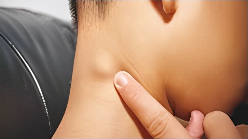 Điều trị lao hạch theo phác đồ của Bộ Y Tế