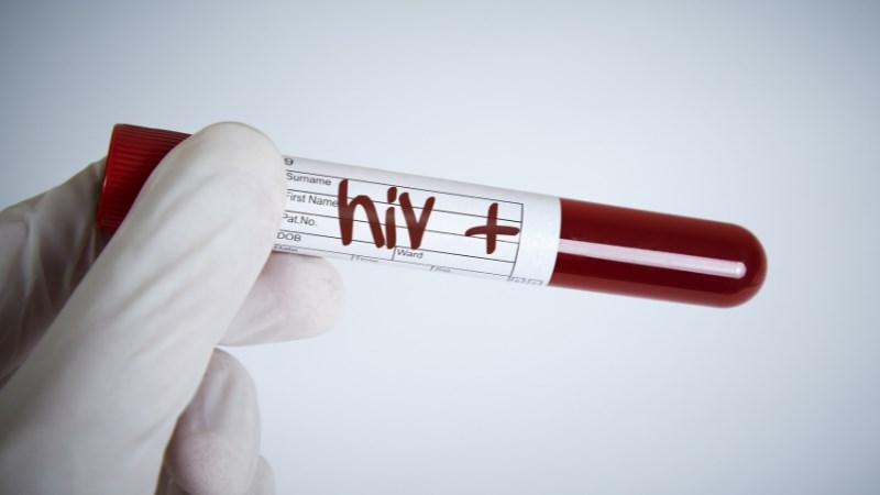 Bệnh nhân nhiễm HIV có nguy cơ cao mắc bệnh lao hạch