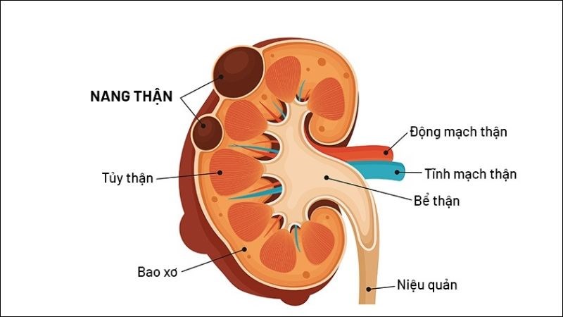 U nang thận là túi tròn chứa dịch hình thành trong thận U nang thận là túi tròn chứa dịch hình thành trong thận
