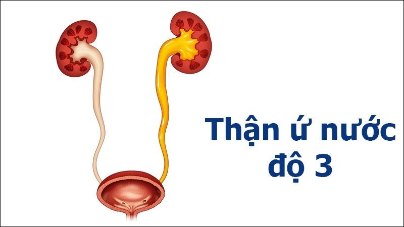U nang thận chèn ép gây ra thận ứ nước U nang thận chèn ép gây ra thận ứ nước