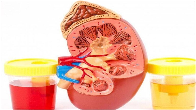 Tiểu ra máu là triệu chứng báo động cần đi khám ngay Tiểu ra máu là triệu chứng báo động cần đi khám ngay