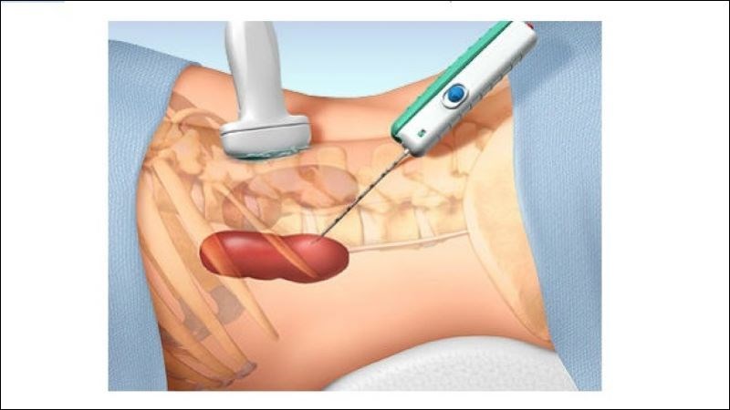 Chọc hút nang thận dưới hướng dẫn siêu âm Chọc hút nang thận dưới hướng dẫn siêu âm