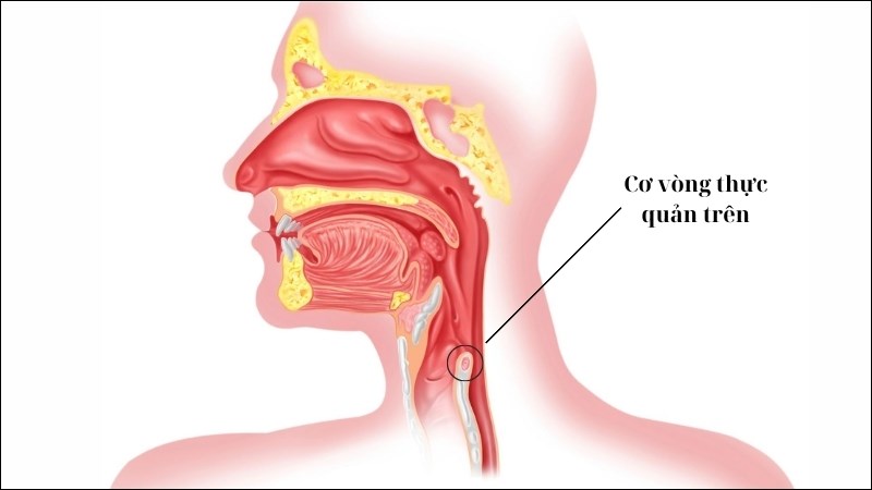 Yếu cơ vòng thực quản trên sẽ làm tăng nguy cơ mắc trào ngược họng - thanh quản