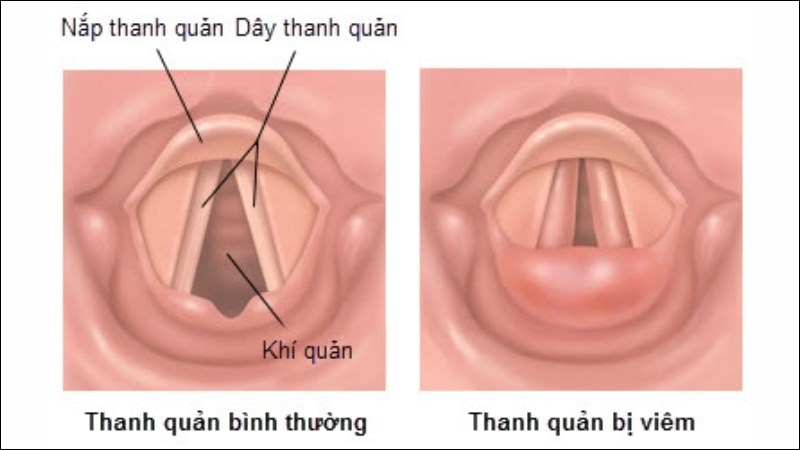 Viêm thanh quản mạn do kích ứng cổ họng thường xuyên là biến chứng của LPR
