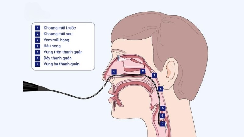 Nội soi thanh quản được sử dụng phổ biến để quan sát tổn thương trong cổ họng