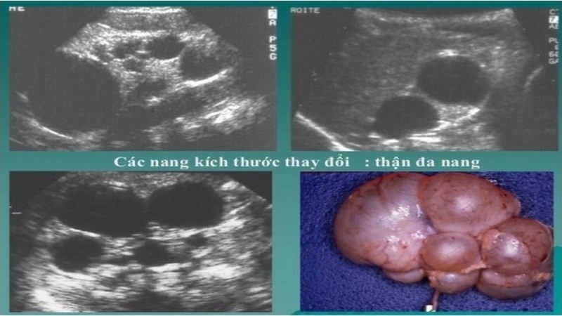 Hình ảnh thận đa nang trên siêu âm