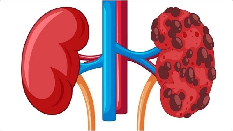 Nhiều nang hình thành trên thận gây suy giảm chức năng thận