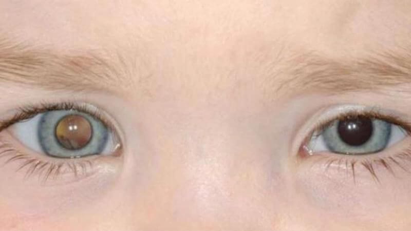 Người rối loạn di truyền u nguyên bào võng mạc sẽ dễ mắc u tuyến tùng hơn những người khác Người rối loạn di truyền u nguyên bào võng mạc sẽ dễ mắc u tuyến tùng hơn những người khác