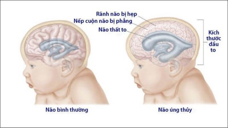 U tuyến tùng có thể gây ra não úng thủy U tuyến tùng có thể gây ra não úng thủy