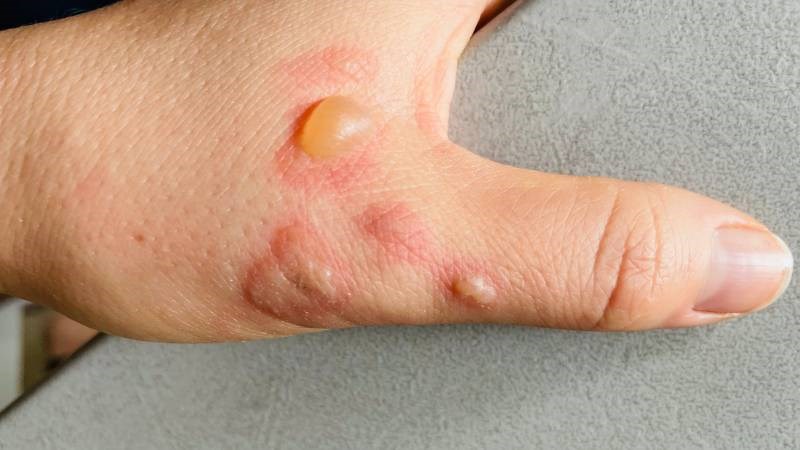 Bỏng là tổn thương ở mô do nhiệt