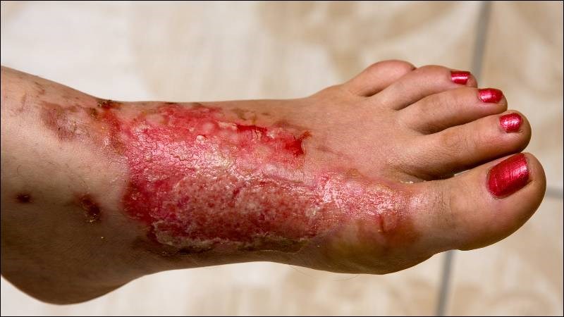 Bỏng da bao phủ bàn chân thì cần được bác sĩ thăm khám