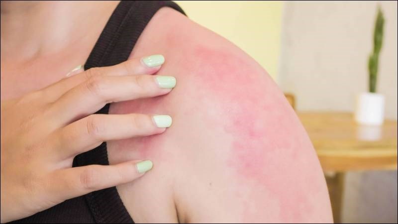 Bỏng cấp độ 1 gây tổn thương da tối thiểu hay còn gọi là “bỏng bề mặt”