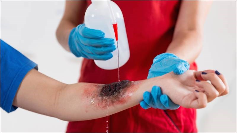 Bỏng cấp độ 3 là tình trạng bỏng gây tổn thương nặng nề