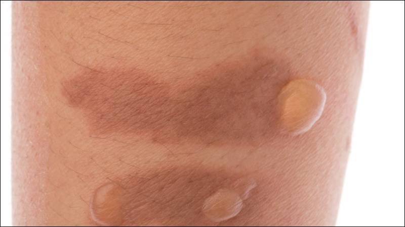 Bọng nước là dấu hiệu thường thấy của bỏng da