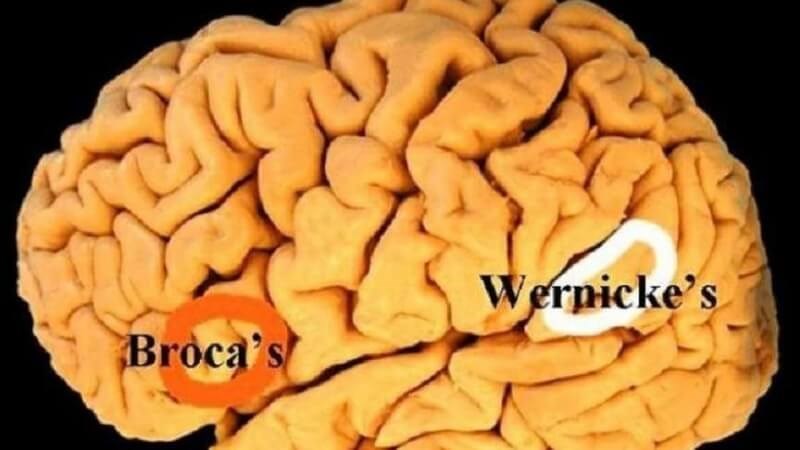 Bệnh não Wernicke là bệnh làm tổn thương vùng Wernicke của não