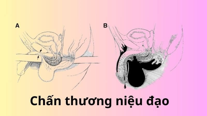 Chấn thương niệu đạo là tình trạng niệu đạo bị tổn thương Chấn thương niệu đạo là tình trạng niệu đạo bị tổn thương