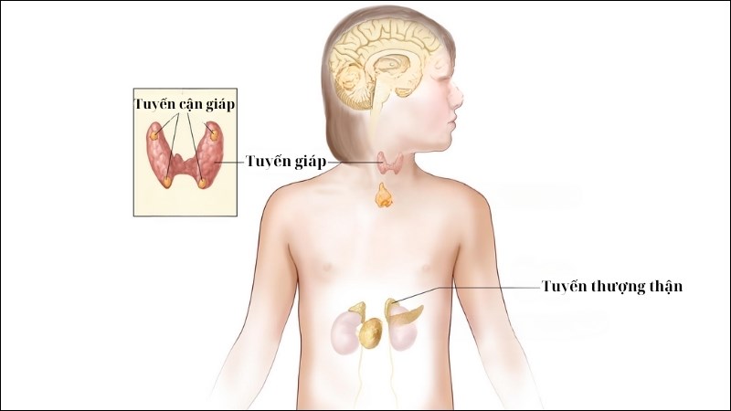 Đa u nội tiết tuýp 1 (MEN 1) có thể là nguyên nhân gây u thần kinh nội tiết